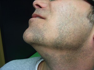 Combler les trous dans la barbe : une autre application de la ...